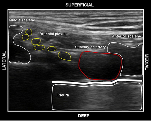 Figure 7: Ultrasound image showing the muscular and vascular structures in the supraclavicular fossa.