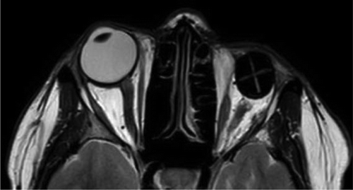Figure 9. MRI before the surgery.