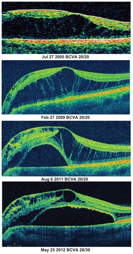 Figure 1 Observed patient with progression of schisis-like cavity over 6 year period.(Patient one, Table 2)