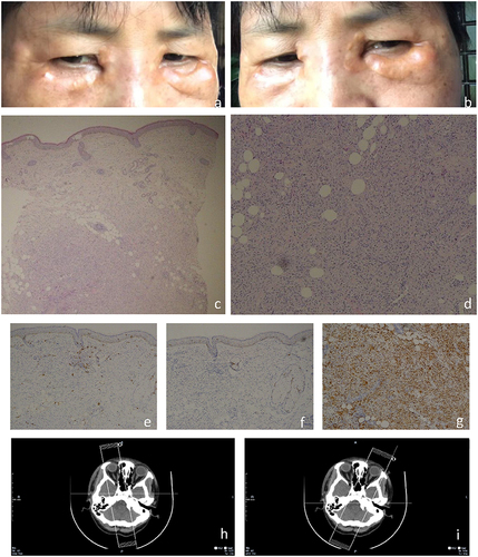 Figure 1 Clinical images and relevant examination results obtained during the patient’s initial visit to our hospital. (a and b) Skin examination unveiled infiltrative symmetrical Orange or brown patches with distinct borders on the inner canthi as well as upper and lower eyelids. The surface was smooth, devoid of scales, atrophy, erosion, or necrosis, and exhibited no tenderness. (c) The epidermis displayed mild hyperplasia, while the dermis exhibited a conglomerate of foam cells, histiocytes, and multinucleated giant cells. Additionally, a minor lymphocytic infiltration was observed around the dermal blood vessels and adnexal structures adjacent to the conglomerate (H and E×50). (d) Intense lymphoplasmacytic infiltration was observed (H&E, magnification ×200). (e) Negative result for S100 immunohistochemistry (magnification ×200). (f) Absence of CD1a immunohistochemical staining (magnification ×200). (g) Positive immunohistochemical staining for CD68 (magnification ×200). (h and i) The axial contrast-enhanced orbital CT scan revealed no abnormalities in either eye. Swelling of the subcutaneous soft tissue was noted in the bilateral maxillofacial region and eyelids, with a subtle prominence on the right side.
