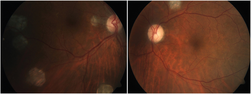 Figure 3. Fundus photograph showing improvement of the chorioretinitis and a pale left optic disc following treatment of Nocardia.