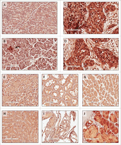 Figure 2. Immunohistochemistry staining of human tissues. Tissue microarrays were stained with anti-human ROR1 antibody with the same specificity and antigen binding arms as the BiTE. (A) and (B) Normal pancreas, with islet cells highlighted (arrow); (C) and (D) pancreatic cancer from two independent patients; (E) normal brain; (F) normal kidney; (G) normal heart; (H) normal liver; (I) normal lung, and (J) normal stomach. All scale bars: 100 μm.
