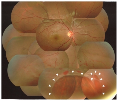 Figure 1 Photograph of the fundus of the right eye at the first visit. Note the bullous retinal detachment in the inferior two quadrants. There are multiple irregular retinal breaks (arrowheads), surrounded by edematous and hemorrhagic retina.