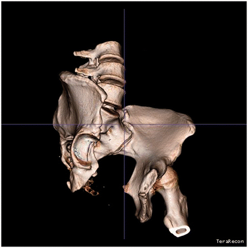 Figure 4. The femur was removed using iNtuition software (TeraRecon, Inc.), applying semi-automatic, region growing-based segmentation. Subsequently, a small parts removal was performed to remove remaining bone fragments; this process also removed all the surgical clips from the image data.