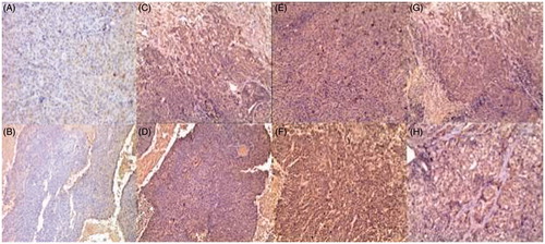 Figure 2. IHC staining of Hsp70 × 100 ACEG took place at the 4 h time point after treatment, and BDFH staining at the 24 h time point. (A, B) Negative Hsp70 expression in the control group. (C, D) Weak positive Hsp70 expression at the necrotic region of the DOX group. (E, F) Positive Hsp70 expression at 4 h and a strong positive expression at 24 h at the coagulation margins of the 20W-MWA group. (G, H (Weak Hsp70 expression in the DOX-MWA group.