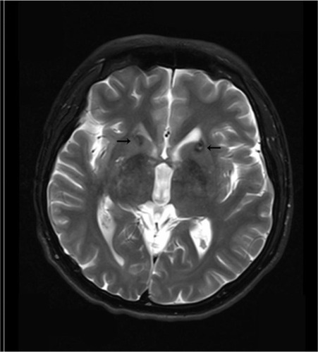 Figure 2 Lesions in the anterior limb of the internal capsule 6 months after surgery.