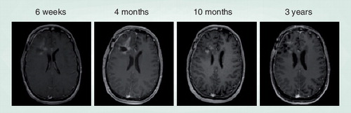 Figure 1. Pseudoprogression example.Sequential contrast-enhanced T1 MRI following radiation plus temozolomide for high-grade glioma are demonstrated. 4 months after completion of chemoradiation, the patient was noted to have progressive contrast enhancement surrounding the resection cavity concerning for tumor recurrence. Temozolomide was continued to complete a 6-month adjuvant course, and imaging findings subsequently improved. The patient now remains without evidence of recurrent disease 3 years postchemoradiation.