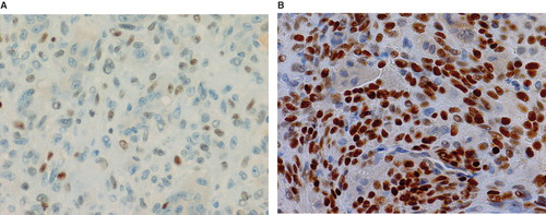 Figure 5. Representative microscopic images of p63 immunostaining for non-recurrent (A) and recurrent GCT cases (B).