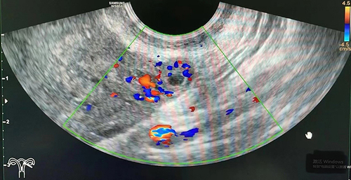 Figure 2 The size of the ectopic pregnancy mass in the left tubal remnant.