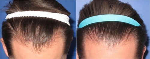 Figure 5 Baseline (left) versus 24-week (right) global photograph of treated (fat + stromal vascular fraction) hairline.