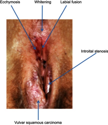 Figure 5 Lichen sclerosus associated with vulvar squamous cell carcinoma.