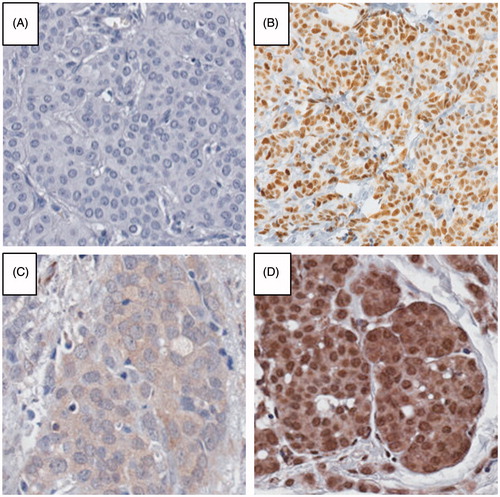 Figure 2. Images depicting staining patterns observed for ERαS305-P using different commercial antibodies and assay protocols. No variability was observed across tumor cores under any given combination of antibody and assay protocol. A: Negative staining using Millipore antibody #05-922 at 1:20 dilution with manual protocol and overnight incubation; B: Positive nuclear staining using Millipore antibody #07-962 at 1:50 dilution with manual protocol and 30 minute incubation; C: Weak cytoplasmic and nuclear staining using Bethyl antibody #A300-598A at 1:300 dilution with manual protocol and overnight incubation; D: Strong cytoplasmic and nuclear staining using Bethyl antibody #A300-598A at 1:100 dilution with manual protocol and overnight incubation.