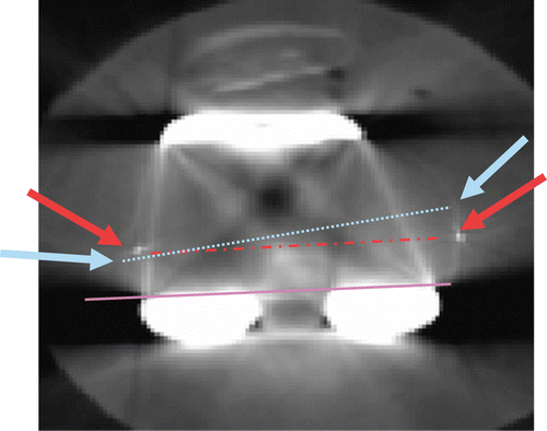 Figure 3. Example of a CT slice (1 mm thick) of the distal femur (blue dotted line = CT-based transepicondylar line; red dashed line = line pointed and marked by tantalum markers; purple solid line = posterior condylar line). The angles between the CT-based and pointed lines and the posterior condylar line were measured. [Color version available online.]