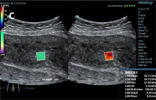 Figure 1 SWE images of postpartum anterior uterine walls.
