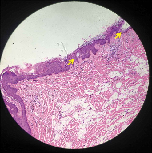 Figure 2. Histology from specimen No.2 demonstrating intra-epidermal LIOB (Hematoxylin and eosin (H&E), 100X).