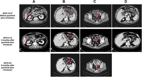 Figure 3 The patient’s condition clinically improved after treatment with pyrotinib and irinotecan. (A) Liver S6 metastasis disappeared after treatment; (B) The diameter of the metastatic peritoneal cyst was reduced from 3.7 to 3.2 cm after treatment and maintained; (C) The diameter of the metastatic peritoneal reflex was reduced from 3.3 to 2.5 cm after treatment and maintained; (D) Ascites were significantly reduced after treatment. Red circles indicate metastatic tumor lesions.