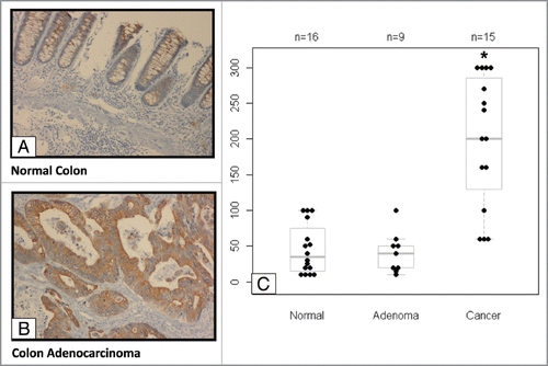 Figure 1 Elevated EP4 receptor expression in human colon cancer specimens. Immunohistochemistry (IHC) staining of EP4 receptor protein was performed in human colon tissue specimens. (A) The staining of normal colonic mucosa shows low EP4 receptor protein expression on the apical membrane. (B) Elevated EP4 staining was observed in adenocarcinomas lesions. (C) Differences between IHC scores for normal, adenomatous, and cancerous lesions are shown as a box and whisker plot. The distribution of pair-wise comparisons of differences in EP4 staining scores shows a significant difference in EP4 receptor staining in malignant colonic lesions compared with normal and adenoma lesions (*p < 0.0001). Each dot represents IHC score (intensity of stain X percentage of cells stained) generated after staining formalin-fixed paraffin embedded tissues for EP4 antibody by IHC.