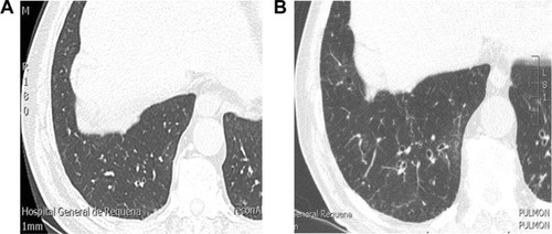 Figure 1 Development of bronchiectasis in a patient with severe COPD.