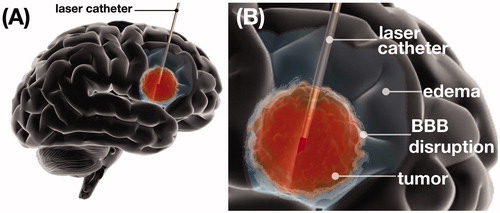 Figure 1. Brain tumor illustration demonstrating laser interstitial thermal therapy (LITT). (A) Schematic representation of intratumoral placement of laser catheter and brain tumor ablation. (B) Schematic representation of brain tumor ablation demonstrating post-LITT contrast enhancement consistent with LITT related blood brain barrier (BBB) disruption and LITT related perifocal edema.