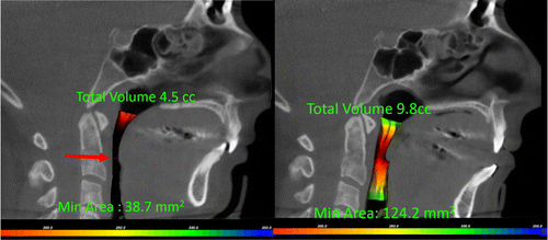 Figure 3 CBCT measures minimal area of the airway and total volume.
