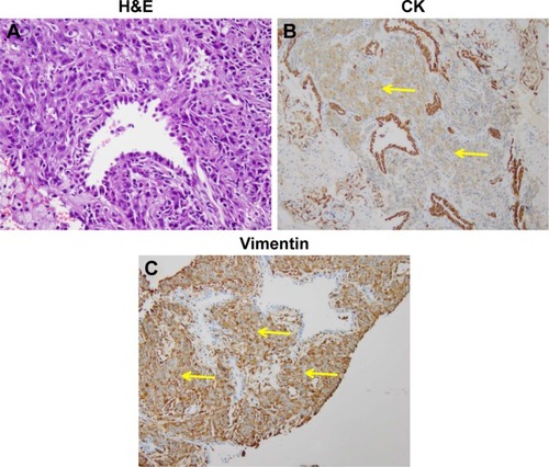 Figure 2 Photomicrographs showing the representative histologic appearance of pulmonary blastoma.