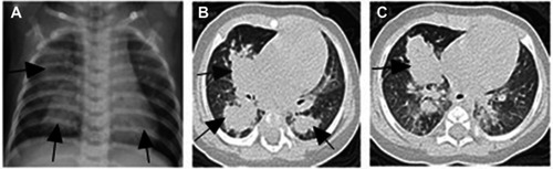 Figure 1 Chest radiograph and chest HRCT scan on admission. (A) showed patchy shadows in the right lung (arrows) and the lower left lung (arrow). (B and C) Multiple masses and small nodules over both lungs (arrows).Abbreviation: HRCT, high-resolution computed tomography.