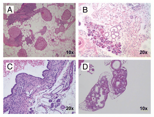 Figure 2 Histopathology of exocrine pancreatic insufficiency in CB and CBP mouse pancreata in the absence of invasive neoplasia. (A) Profound loss of exocrine pancreatic parenchyma in a CB mouse at 6 months age demonstrating extensive adipose (fatty) replacement and residual islets with minimal functioning exocrine tissue (H&E stain, 10× magnification). (B) Minimal residual exocrine parenchyma (acinar tissue) in a six month old CBP mouse (H&E stain, 20× magnification). (C) Degenerated cystic lesions observed in both CB and CBP mice, lined by flattened cuboidal epithelium and often containing hemorrhagic fluid (H&E stain, 20× magnification). (D) Strips of murine pancreatic intraepithelial neoplasia (mPanIN) are observed in a background of adipose (fatty) replacement and near total absence of viable acinar tissue in a 15-month-old CB mouse (H&E stain, 10× magnification).