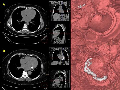Figure 2 Slab image at the level of the mitral valve. Right images - virtual reality endoscopic reconstruction in 3D looking from the roof of the left atrium towards the mitral valve, showing calcium in in silver. Left images: Heart CT scan. (A) Patient without MAC, (B) Patient with MAC.