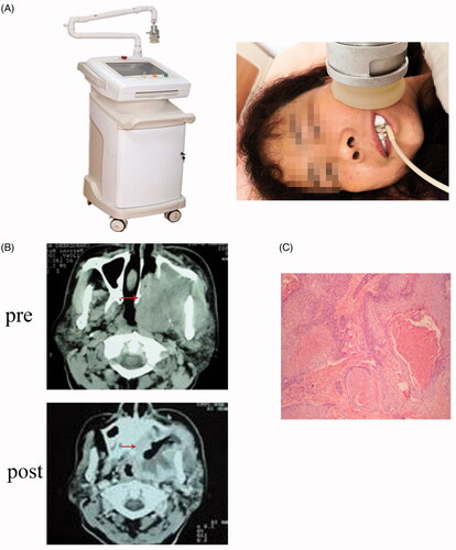 Figure 1. (A) Ultrasonic thermal therapy system; (B) Representative CT scan of OSCC patients pre- and post-hyperthermia therapy; (C) Representative section of hematoxylin and eosin staining post-hyperthermia therapy in OSCC patients.
