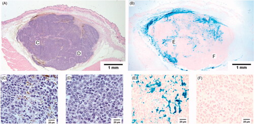 Figure 9. A representative MTGB tumour with histological sections taken 5 min after mNP injection. These H&E and Prussian blue photomicrographs demonstrate regional heterogeneity in mNP distribution. The 110 nm diameter mNP were injected in four tissue quadrants, with a total of 7.5 mg of Fe per cm3 tumour, 5 min prior to tumour removal and processing. Regions indicated on the low magnification images are shown in the high magnification images. H&E and Prussian blue. (A, B) 10 × magnification, (C, D, E, and F) 100 × magnification.