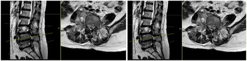 Figure 3 T2WI, epidural abscess in the spinal canal of L3–5.