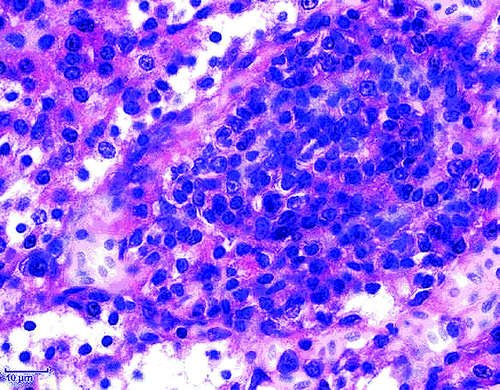 Figure 3.  Focal mononuclear cell hyperplasia (lymphocytes and plasma cells) in the kidney. H & E stain (scale bar=10 µm).