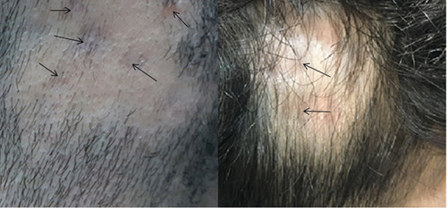 Figure 3 Skin atrophy observed at sites of ILT injection (arrows).