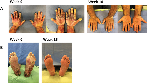 Figure 5. Changes in psoriasis skin lesions during treatment with secukinumab: cases 4 (A) and 5 (B).