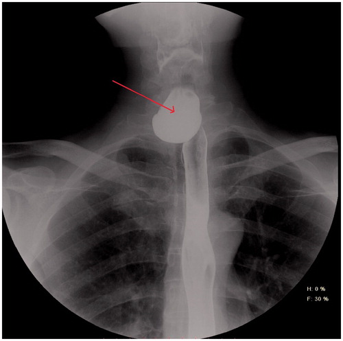 Figure 1. Contrast oesophagoscopy, postero-anterior view.