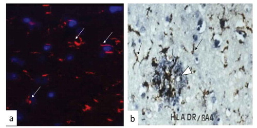 Figure 1. Brain tissue showing microglia responding to infection in a mouse model and to Aβ plaque in a brain tissue section from Alzheimer’s disease.