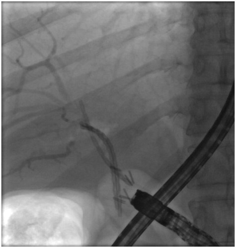 Figure 5. The fluoroscopy view of Archimedes stents of patient with hepaticojejunostomy anastomotic stricture (number 3) showing good visibility of the stents.