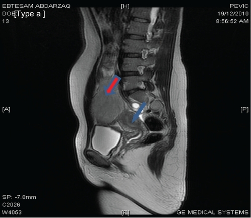 Figure 2 Pelvi-abdominal MRI showing a large, well-defined, oval mass measuring 12 × 8 cm in dimensions overlapping the right side of the pelvic cavity (red arrow). The mass appears to be connected to the uterus (blue arrow). A subserosal leiomyoma is suggested. However, a desmoid tumor needs to be excluded.