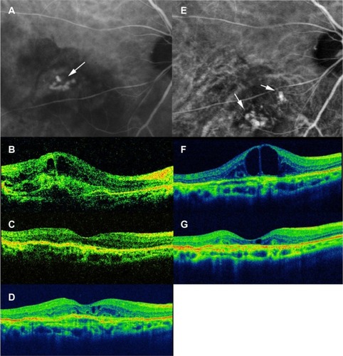 Figure 1 Right eye of an 80-year-old female with polypoidal choroidal vasculopathy.