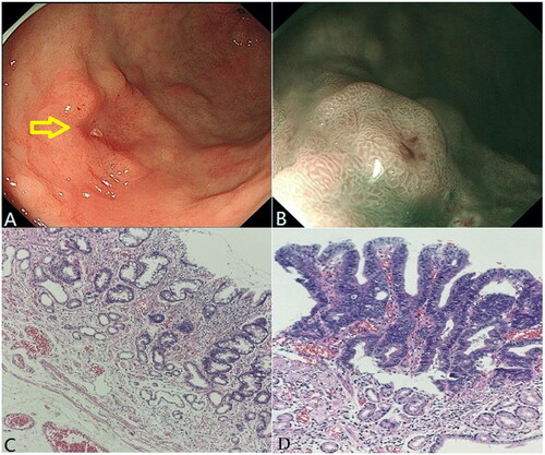 Figure 2. Well-differentiated adenocarcinoma after Helicobacter pylori eradication of a middle-aged male patient. (A) White light endoscopy image. The yellow arrow indicates the lesion location. (B) NBI image. (C) Normal gastric mucosa surrounding the tumor (HE,×100). (D) Well-differentiated adenocarcinoma area (HE, ×400).