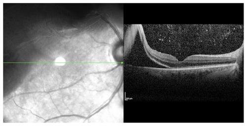 Figure 1 Preoperative optical coherence tomography of the right eye of a 69-year-old female with a rhegmatogenous retinal detachment. The macula is detached, but the fovea is attached. Preoperative visual acuity (VA) was 20/30. The external limiting membrane and inner segment/outer segment junction of the photoreceptors are preserved under the fovea. There is no evidence of outer retinal corrugation. There is an absence of cystoid macular edema. The detachment was surgically repaired with a pars plana vitrectomy. The VA 1-month postoperatively was 20/30.