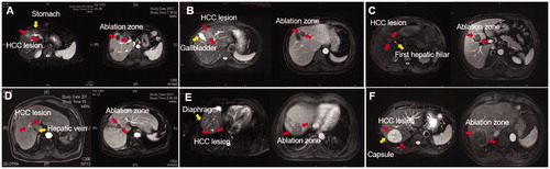 Figure 2. The HCC lesions in six types of CLs underwent US-PMWA. (A) MRI scan showed a nodule (red arrow) abutting to the stomach (yellow arrow) before MWA on the T2-weighted image and an ablation zone (red arrow) after MWA on the delay phase image. (B) MRI scan showed a nodule (red arrow) abutting to the gallbladder (yellow arrow) before MWA on the T2-weighted image and an ablation zone (red arrow) after MWA on the delay phase image. (C) MRI scan showed a nodule (red arrow) abutting to the first hepatic hilar (yellow arrow) before MWA on the T2-weighted image and an ablation zone (red arrow) after MWA on the delay phase image. (D) MRI scan showed a nodule (red arrow) abutting to the hepatic vein (yellow arrow) before MWA on the hepatic arterial phase image and an ablation zone (red arrow) after MWA on the delay phase image. (E) MRI scan showed a nodule (red arrow) abutting to the diaphragm (yellow arrow) before MWA on the T2-weighted image and an ablation zone (red arrow) after MWA on the delay phase image. (F) MRI scan showed a nodule (red arrow) abutting to the capsule (yellow arrow) before MWA on the T2-weighted image and an ablation zone (red arrow) after MWA on the delay phase image.