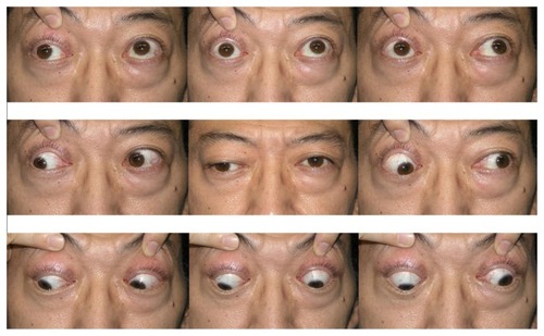 Figure 2 Patient’s eye positions in nine directions of gaze before edrophonium chloride administration.