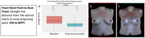 Figure 11. The front neck point to bust point measurement (sternal notch to most projecting point) for the participants who underwent bilateral implant-based reconstruction significantly decreased in the reconstructed breast after implant-based reconstruction (right breast: p < 0.001, left breast: p < 0.001). (A) Boxplot (median and interquartile range) of the front neck point to bust point measurement at baseline and post-reconstruction for the right breast (left was similar). (B) The front neck point to bust point measurement on an exemplar patient at baseline. (C) The front neck point to bust point measurement on the same patient post-reconstruction.