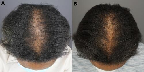 Figure 3 Top of the head of patient 2 Images of the top of the head of a patient diagnosed with central centrifugal cicatricial alopecia obtained before (A) and after (B) 5 months of treatment with Gashee lotion and oral supplements.
