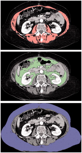 Figure 1. Measurement of body composition parameters using axial CT slice at the level of the third lumbar vertebra. (a) Delineation of total muscle area (pink), using a threshold of −29 to +150 HU. (b) Delineation of visceral (green) and (c) subcutaneous (blue) fat areas, using a threshold of −190 to −30 HU.