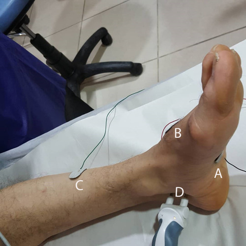 Figure 2 The sites of recording SSR from tibial nerve. (A) active electrode on the sole; (B) reference electrode on the dorsal aspect of the foot, (C) ground electrode on the leg and (D) stimulate tibial nerve on the posterior to the medial malleolus.