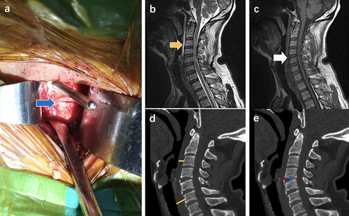 Figure 3 (a) The blue arrow’s place was the ruptured anterior longitudinal ligament. (b) On the T2 weighted phase of MRI, the yellow arrow’s place was T2HS, and the area was 2.686cm ². (c) The low signal intensity of the anterior vertebra was interrupted in the C4/5 segment (white arrow). (d) The thickness of prevertebral soft tissue of C3 and C6 was 0.9 cm and 1.7cm respectively (yellow line). (e) The IDA of C4/ 5 was 32.035° (blue line).