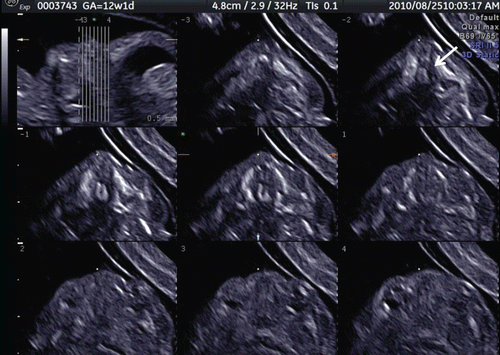 Figure 39.  Tomographic ultrasound imaging of cleft plate at 12 weeks of gestation. Unilateral cleft palate is demonstrated (arrow).