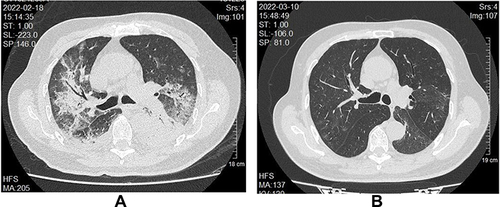 Figure 3 Chest imaging of a 78-yr-old man with C. psittaci infection before and after treatment. (A) Pre-treatment computed tomography (CT) scan showing bilateral large consolidation with air bronchogram in right lung and bilateral pleural effusion. (B) Follow-up CT scan after combination therapy for 20 days showing the consolidation and pleural effusion disappeared.